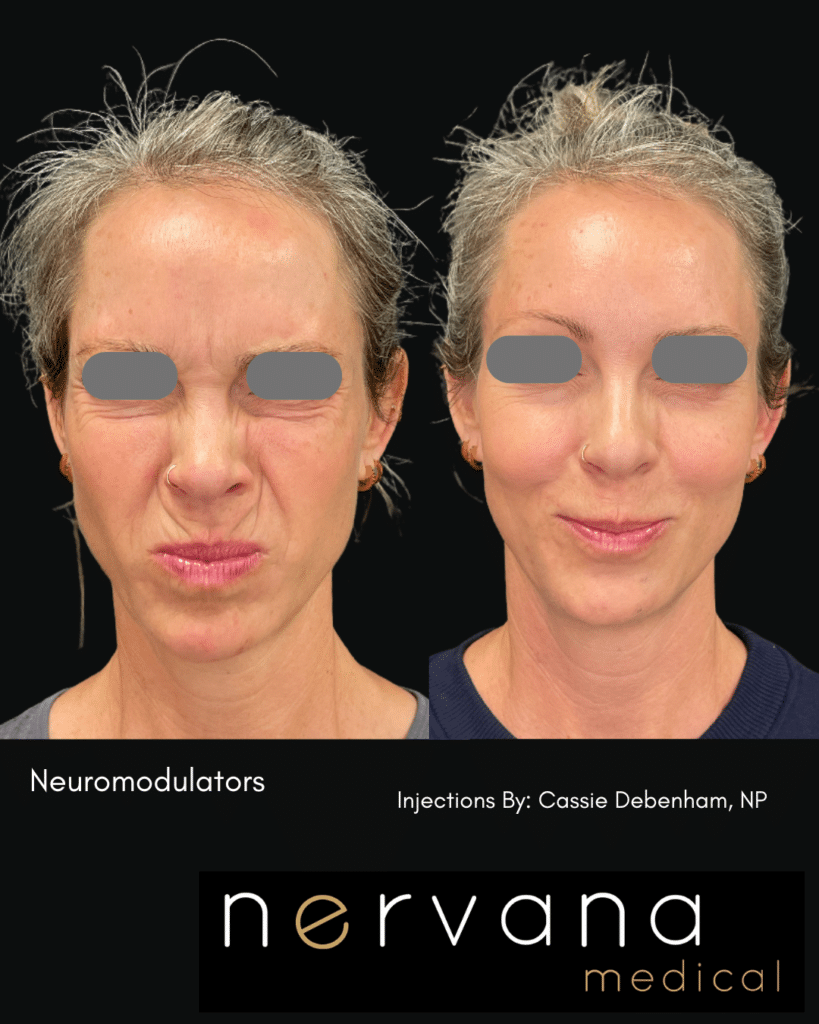 Before and After Image: FULL-FACE + NECK NEUROMODULATOR REJUVENATION - right-front-oblique