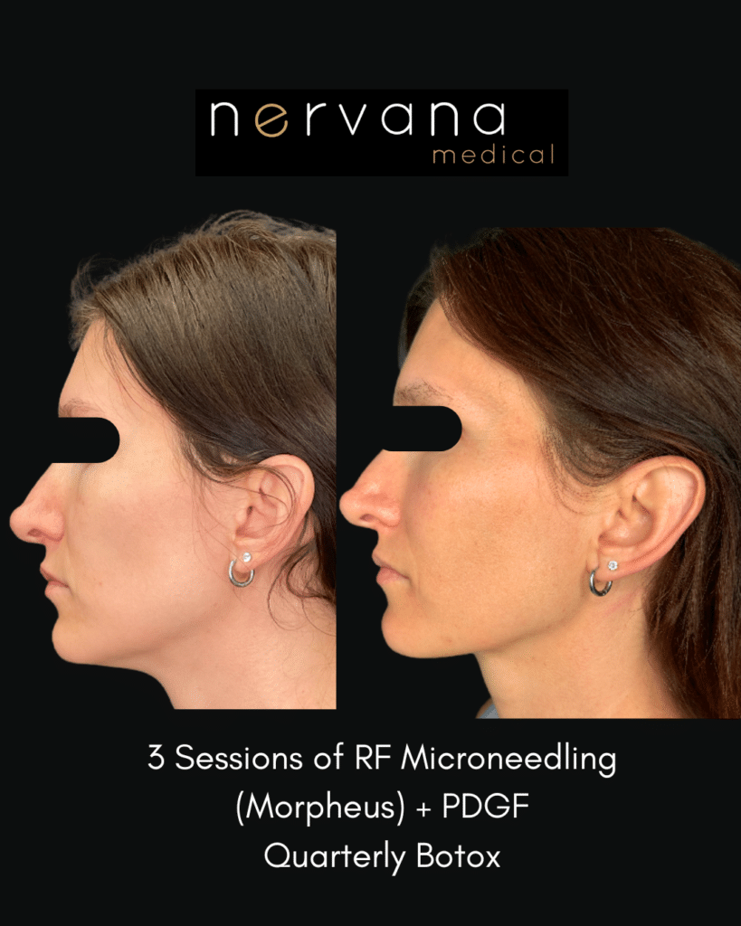 Before and After Image: Morpheus + PDGF - front