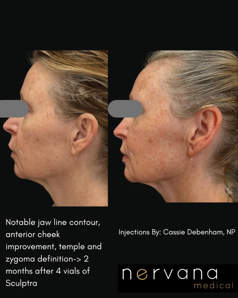 Before and After Image: Sculptra®Don’t Fill It. Rebuild It. - front