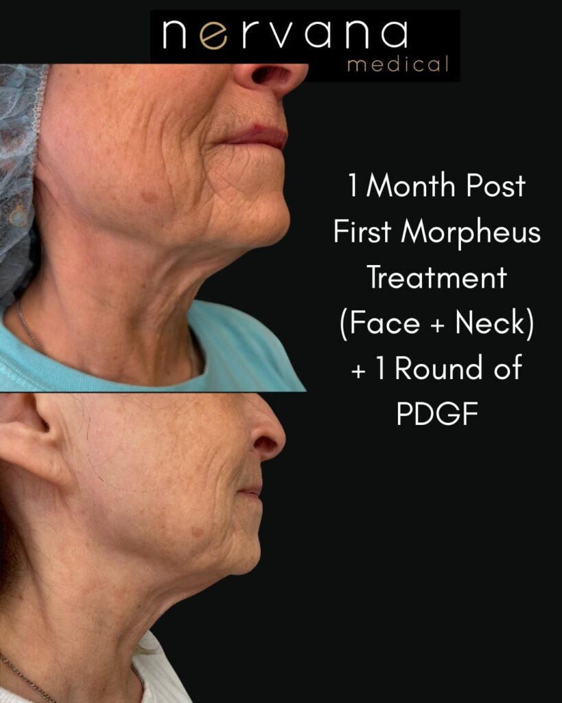 Before and After Image: RF Microneedling with Morpheus 8 + PDGF - front