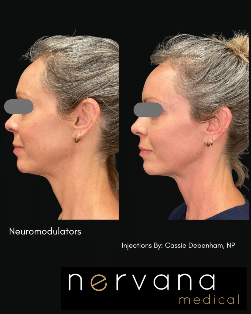 Before and After Image: FULL-FACE + NECK NEUROMODULATOR REJUVENATION - left-back-oblique