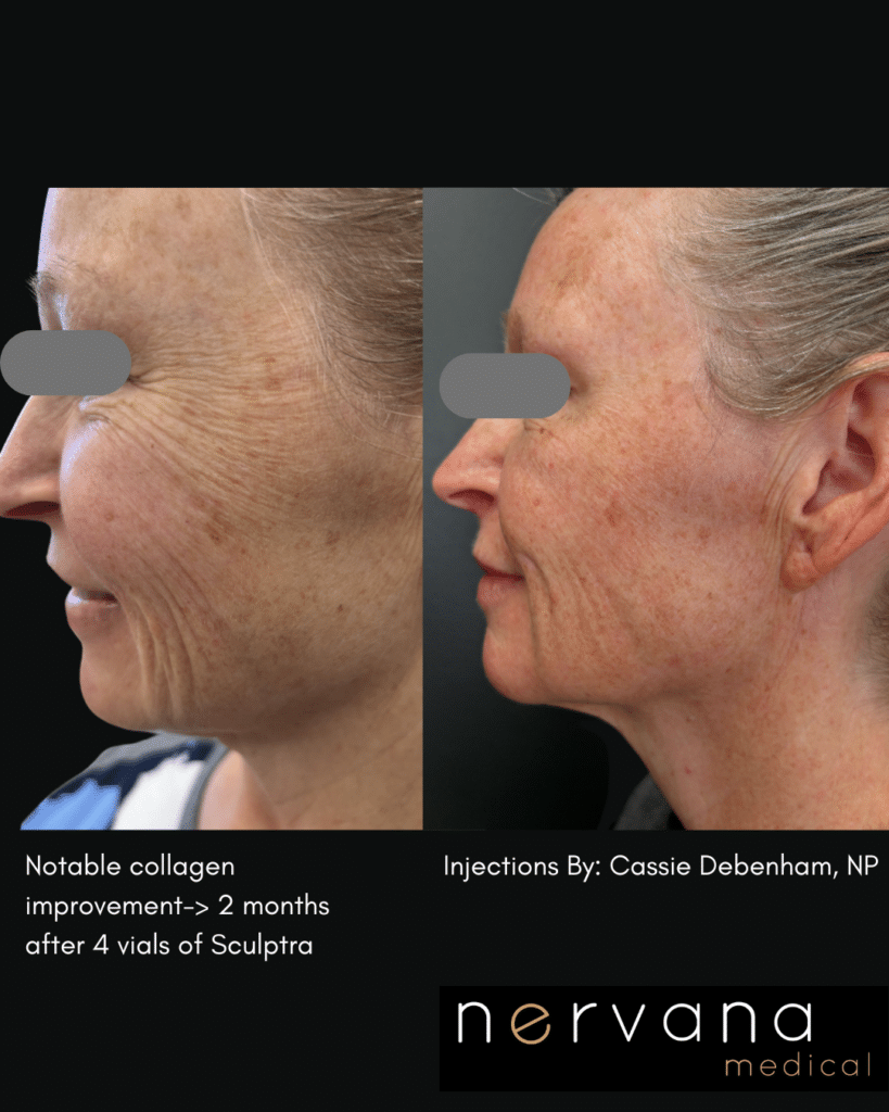 Before and After Image: Sculptra®Don’t Fill It. Rebuild It. - front