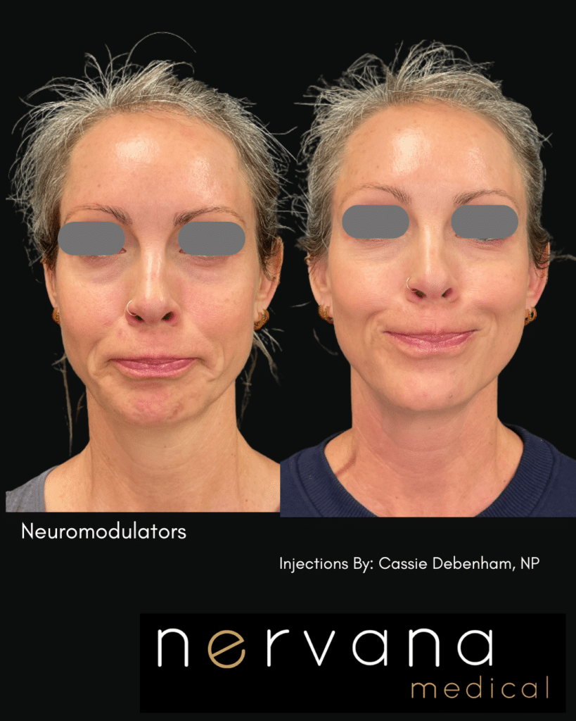 Before and After Image: FULL-FACE + NECK NEUROMODULATOR REJUVENATION - back