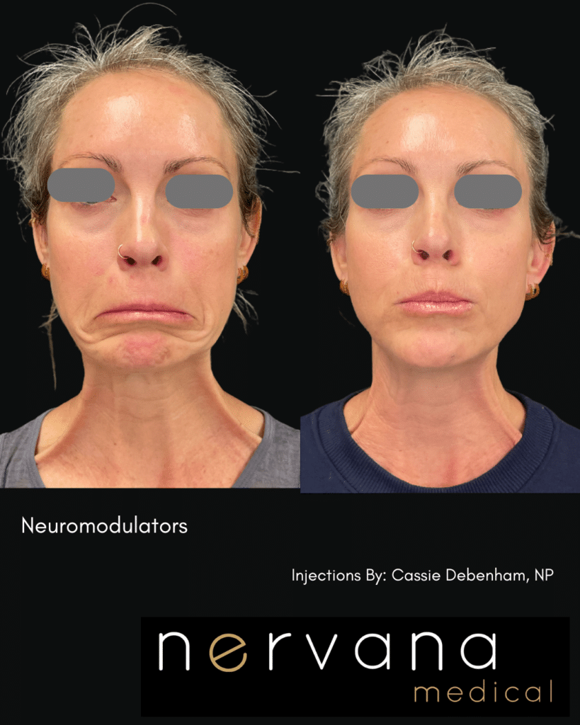 Before and After Image: FULL-FACE + NECK NEUROMODULATOR REJUVENATION - front