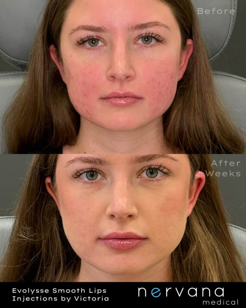 Before and After Image: Natural, Beautiful Lip Filler at Nervana Medical - front