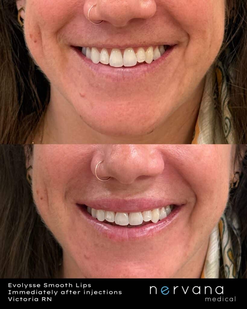 Before and After Image: Lip Filler - front