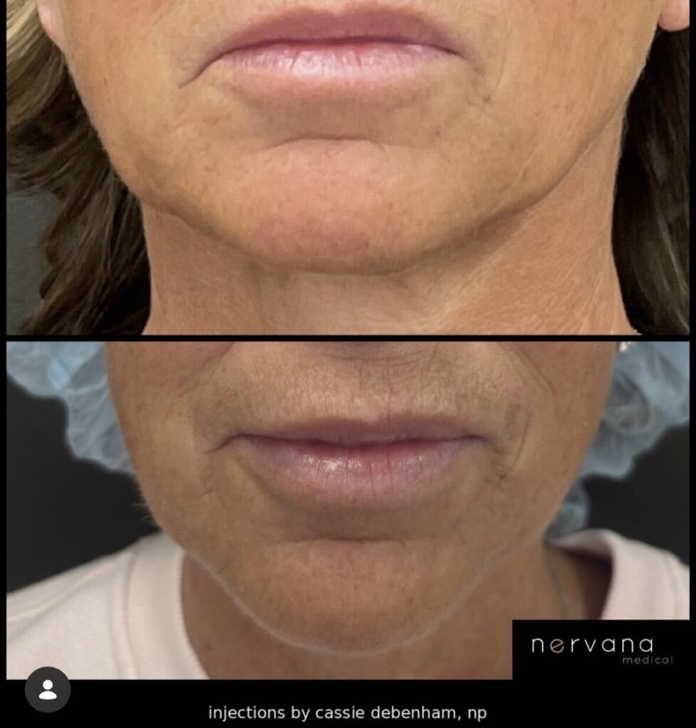 Before and After Image: Chin Tox: The Tiny Treatment That Makes a Big Difference - front