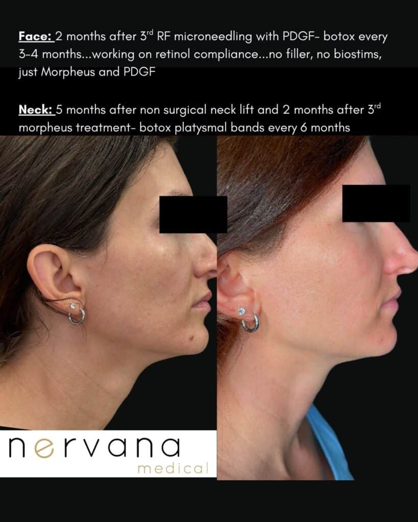Before and After Image: Morpheus Face, Morpheus + Radiesse Neck - right-front-oblique