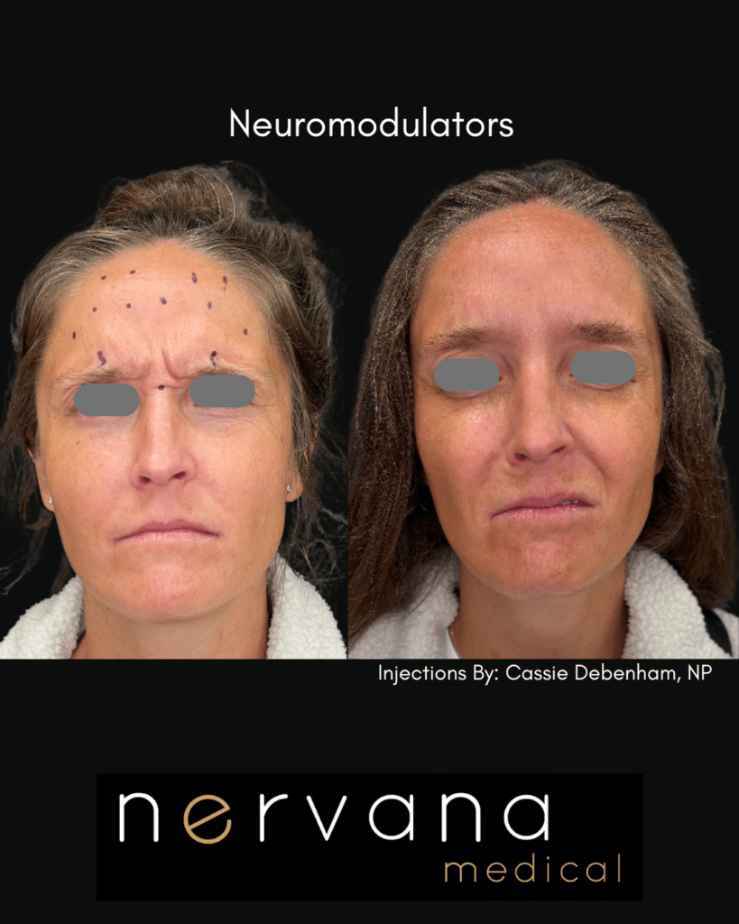 Before and After Image: The Most Popular Anti-Aging Treatment for a Reason - front