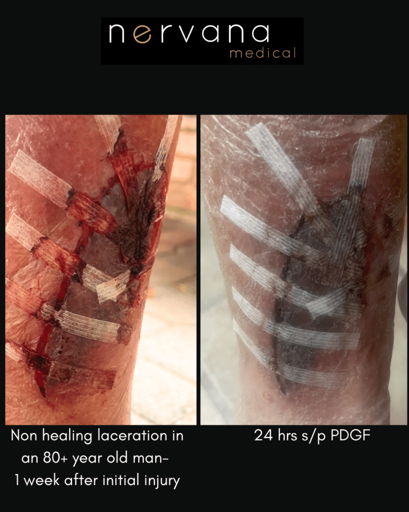 Before and After Image: PDGF For Wounds - front