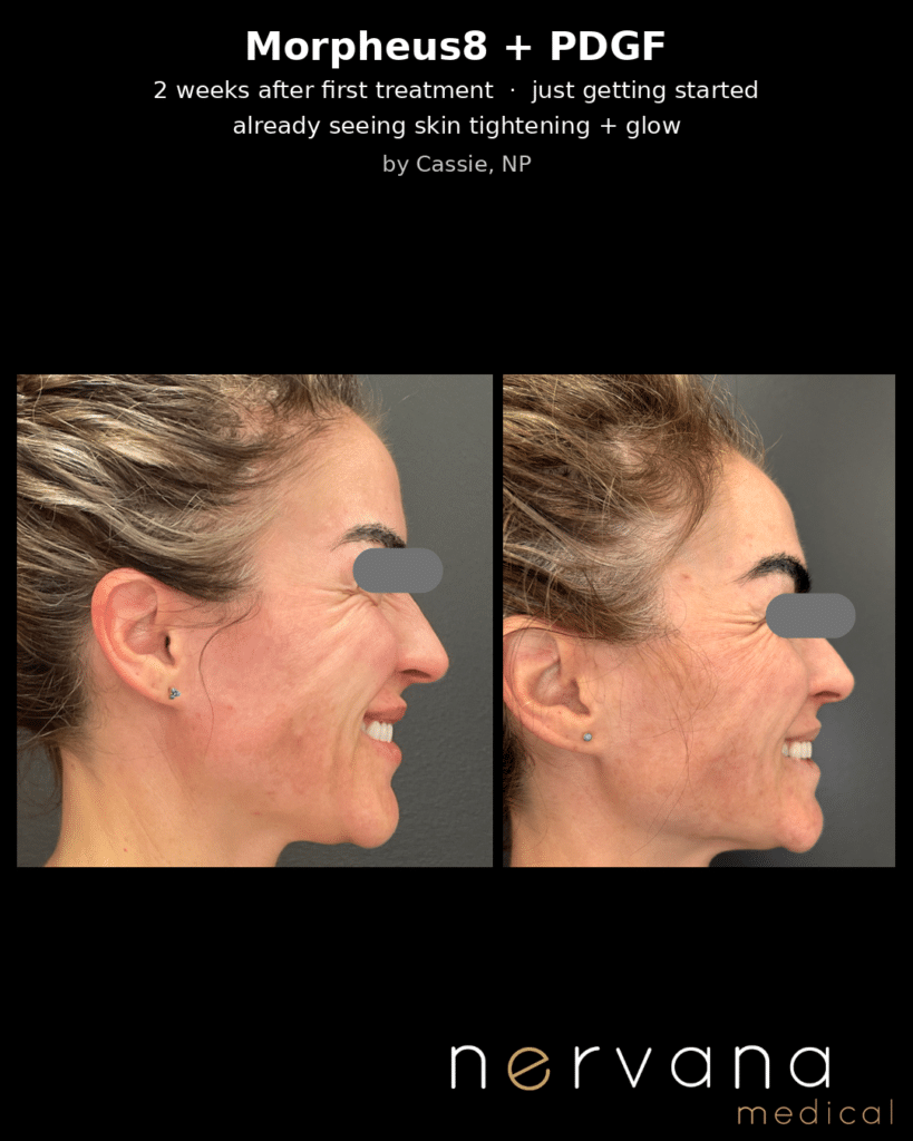 Before and After Image: The Ultimate Collagen-Stimulating Combination: Morpheus8 + PDGF - front