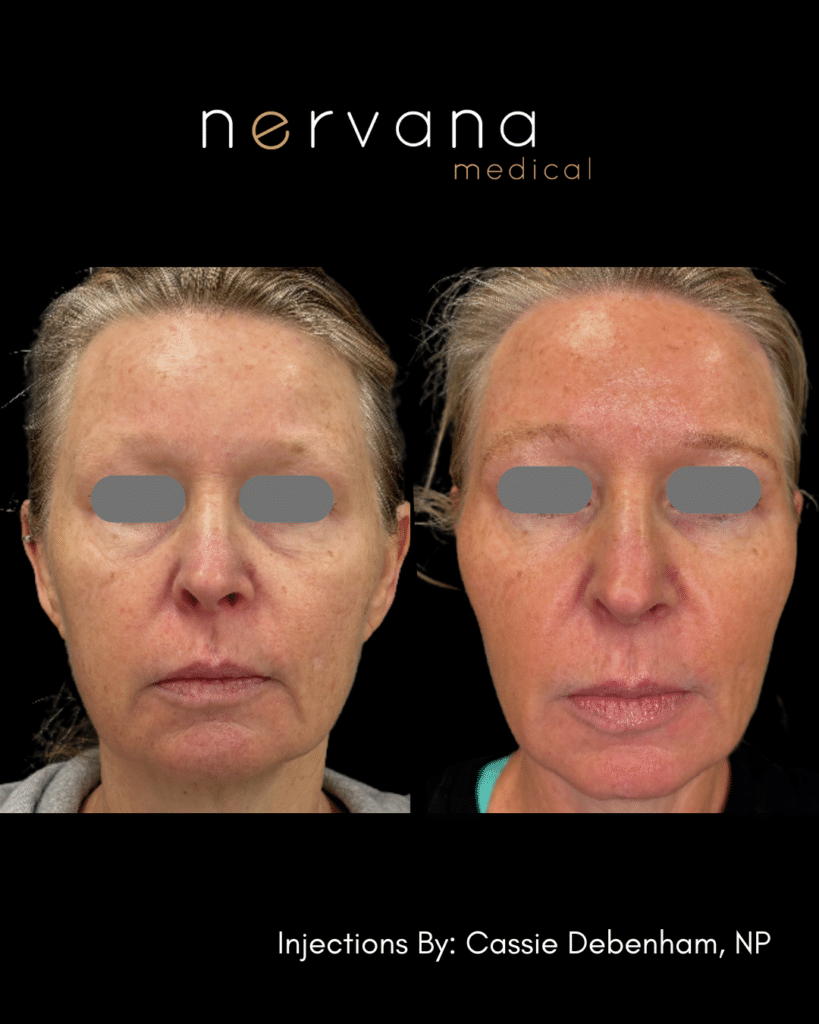 Before and After Image: Sculpt and Lift Rejuvenation - front