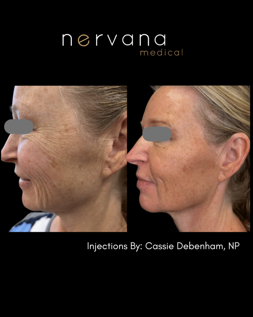 Full-Face Balancing before and after results, view 2, patient 1, at Nervana Medical in Sandy, UT