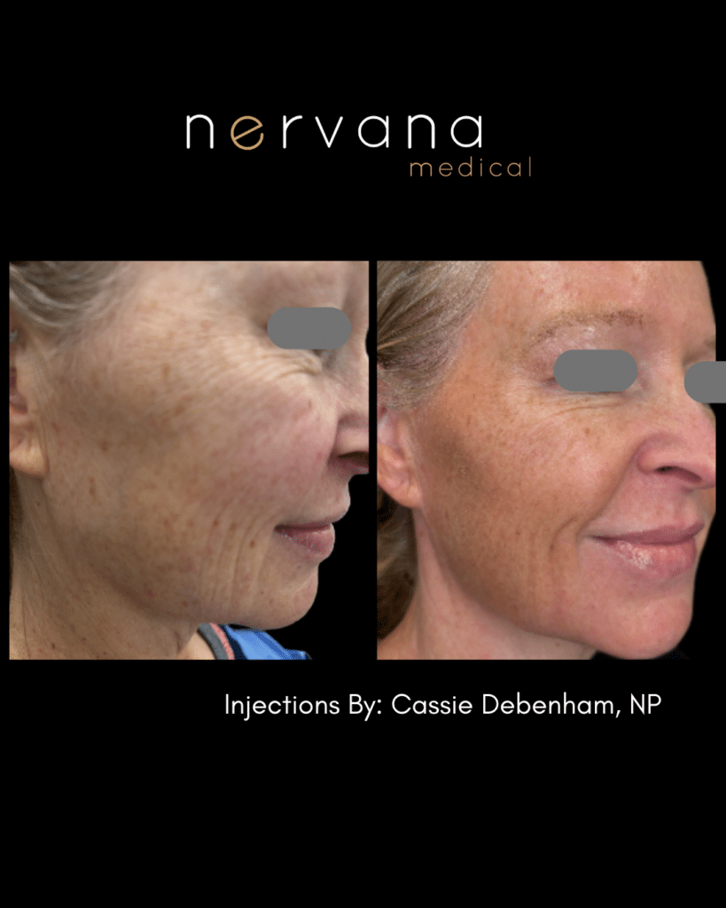 Before and After Image: Sculpt and Lift Rejuvenation - front
