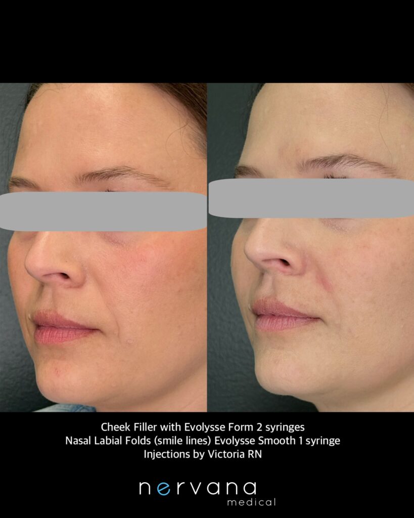 Before and After Image: Cheek Filler & Facial Contouring at Nervana Medical - left-front-oblique