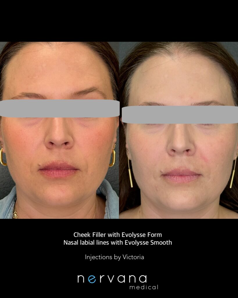 Before and After Image: Cheek Filler & Facial Contouring at Nervana Medical - front