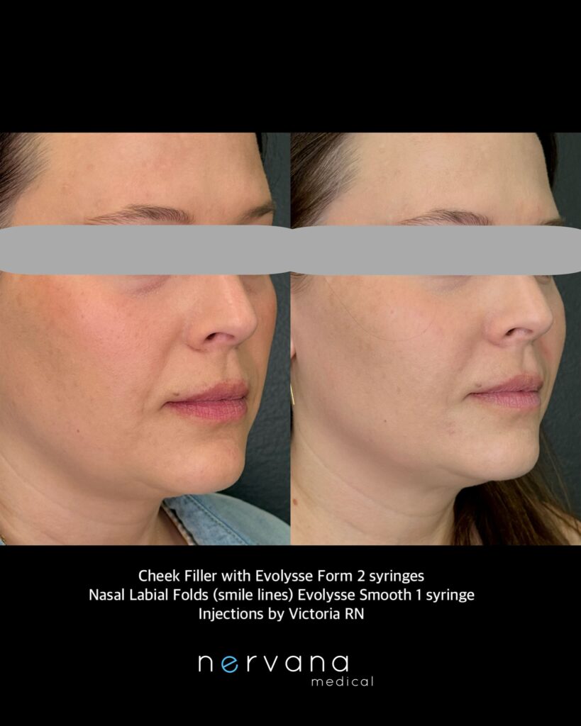 Before and After Image: Cheek Filler & Facial Contouring at Nervana Medical - right-front-oblique