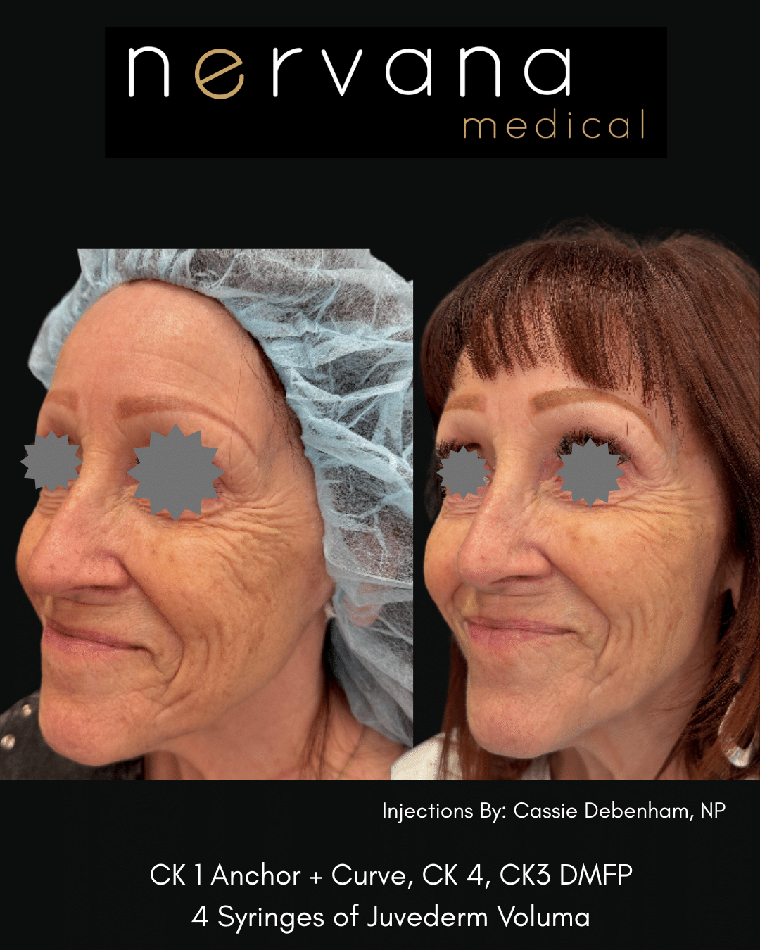 Before and After Image: Juvederm Fillers- Cheek Support - front
