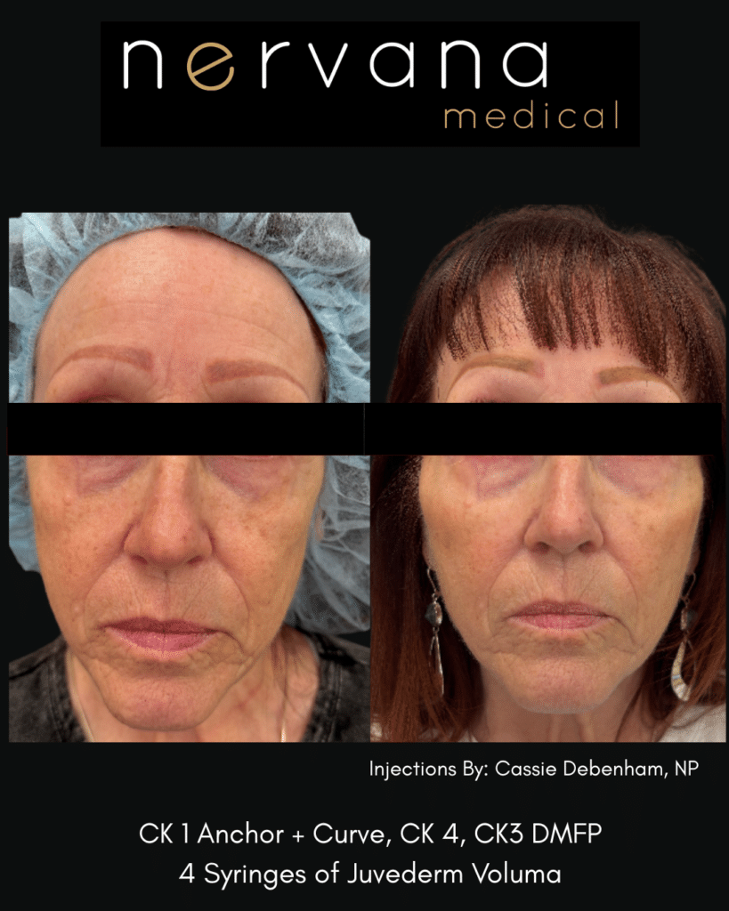 Before and After Image: Juvederm Fillers- Cheek Support - front