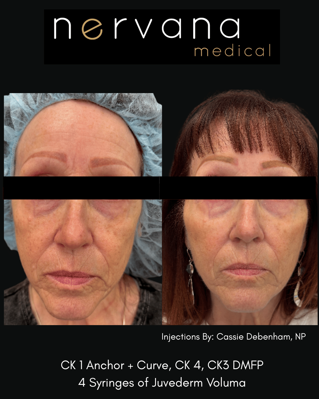 Before and After Image: Juvederm Fillers- Cheek Support - front