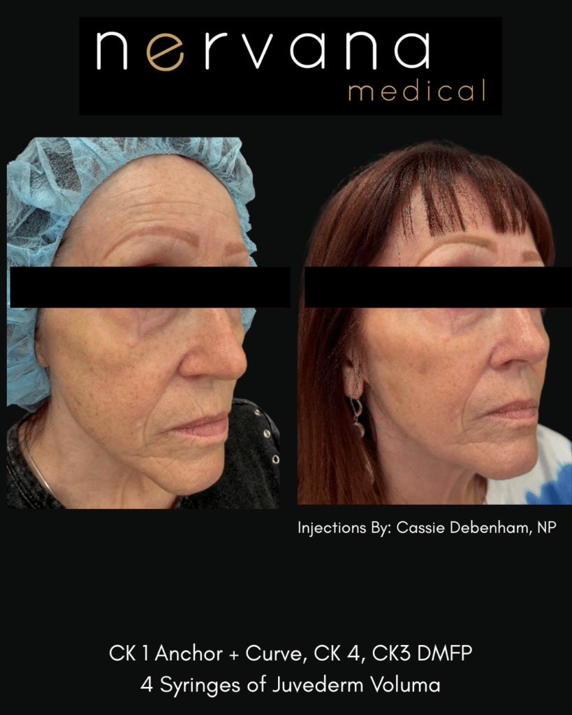 Before and After Image: Juvederm Fillers- Cheek Support - right-front-oblique
