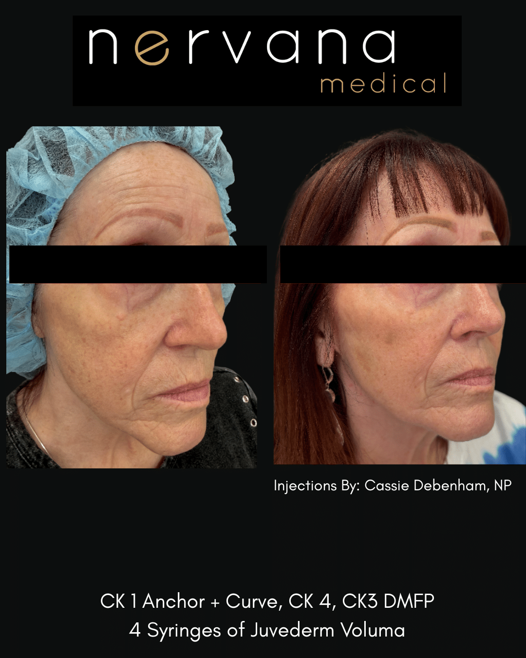 Before and After Image: Juvederm Fillers- Cheek Support - front