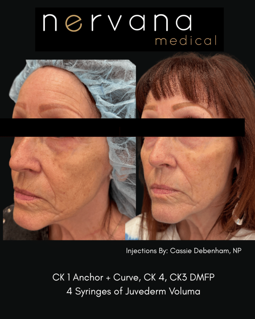 Before and After Image: Juvederm Fillers- Cheek Support - left-front-oblique
