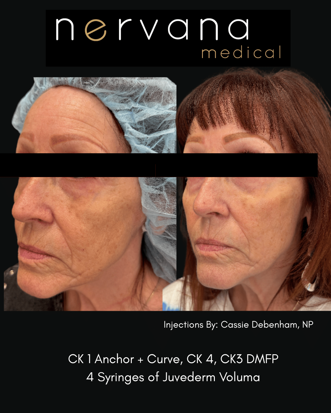 Before and After Image: Juvederm Fillers- Cheek Support - front
