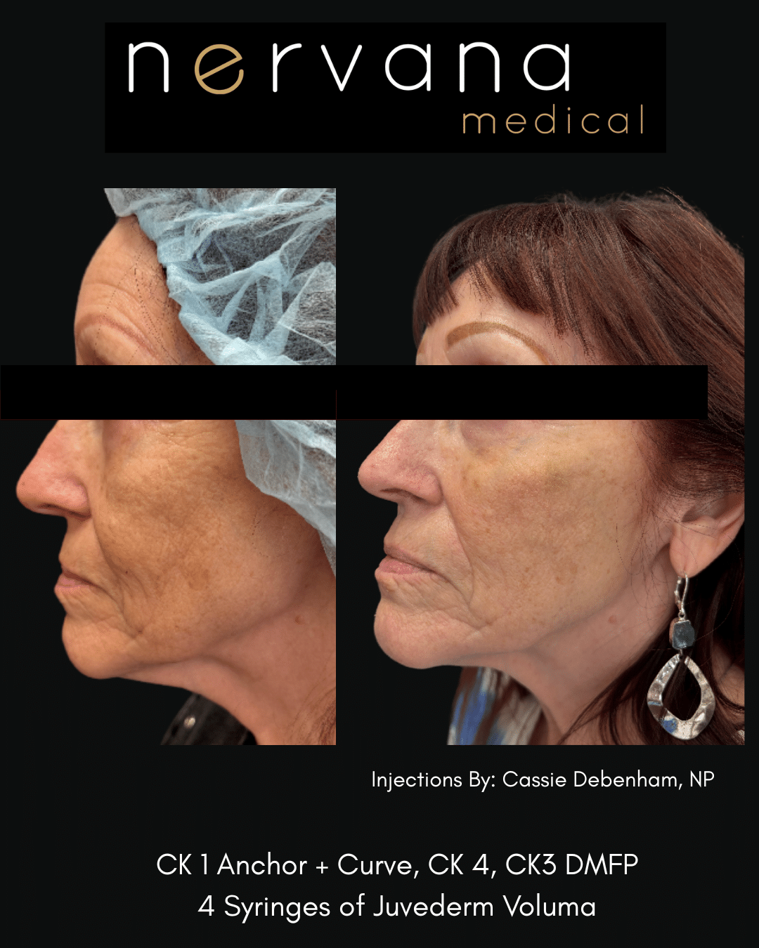 Before and After Image: Juvederm Fillers- Cheek Support - front
