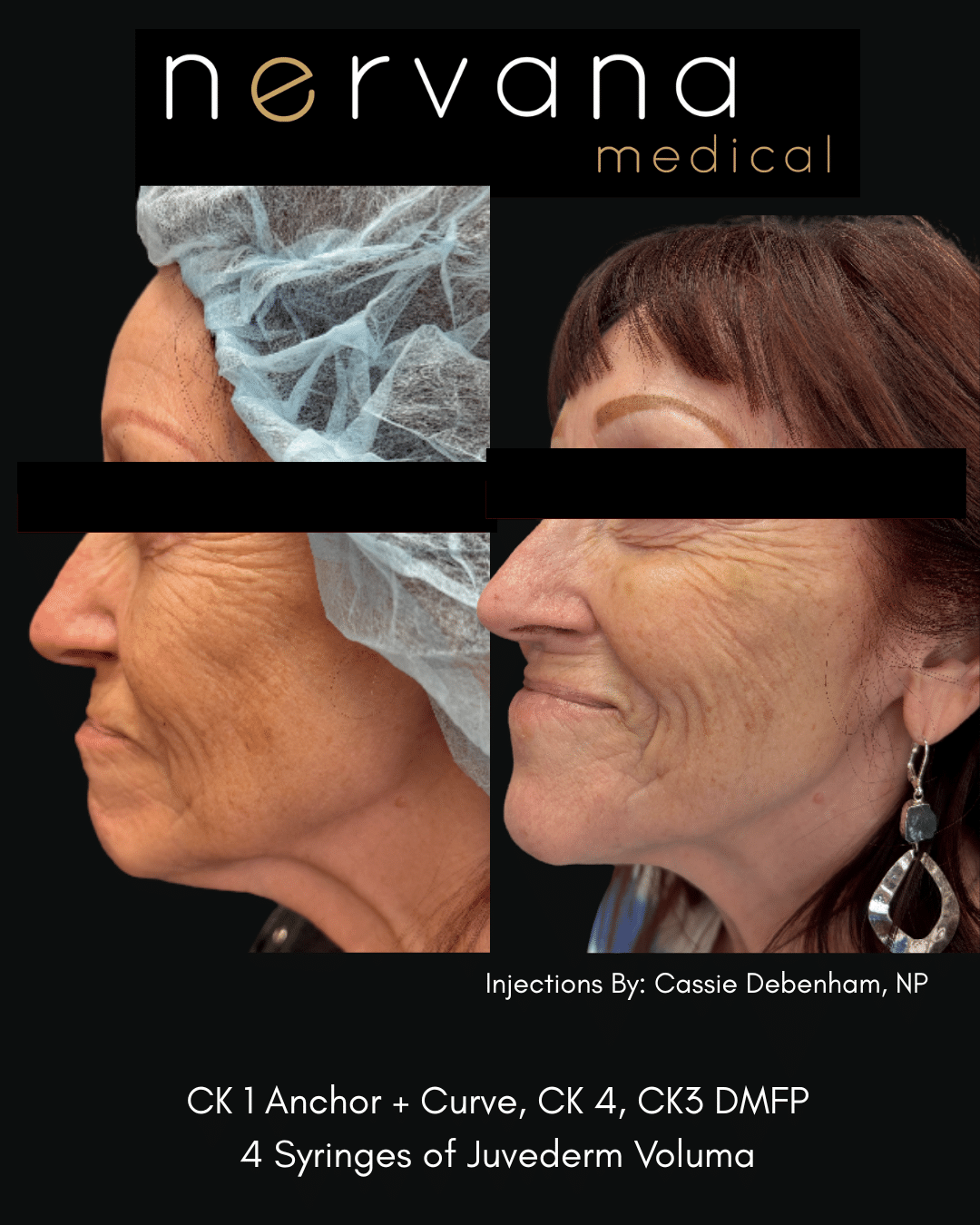 Before and After Image: Juvederm Fillers- Cheek Support - front