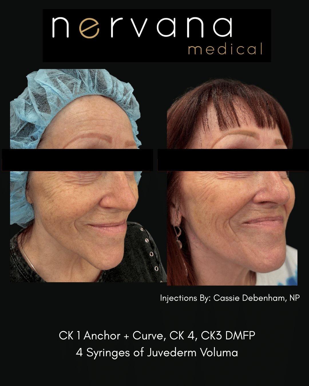 Before and After Image: Juvederm Fillers- Cheek Support - front