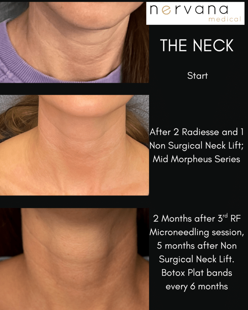 Before and After Image: Morpheus + Radiesse Neck - front
