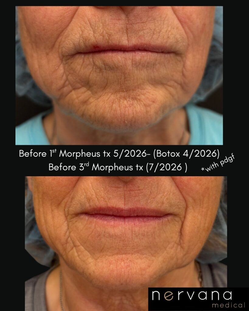 Before and After Image: Morpheus and PDGF - front