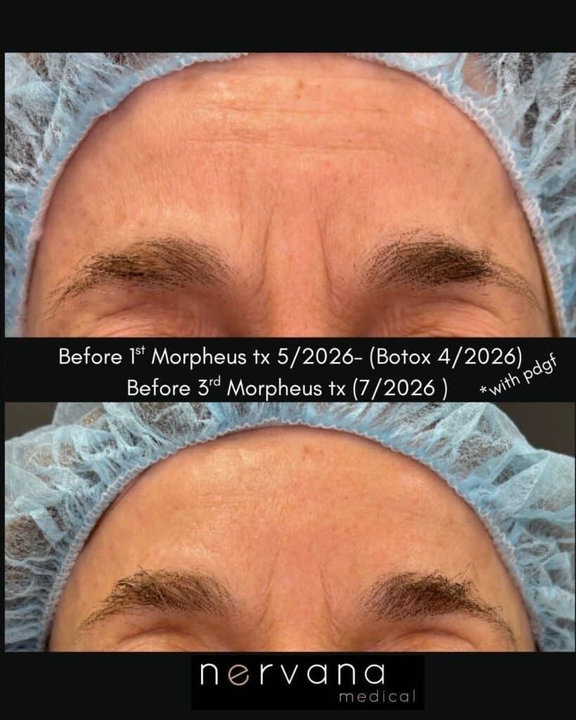 Before and After Image: Forehead Wrinkles… - front