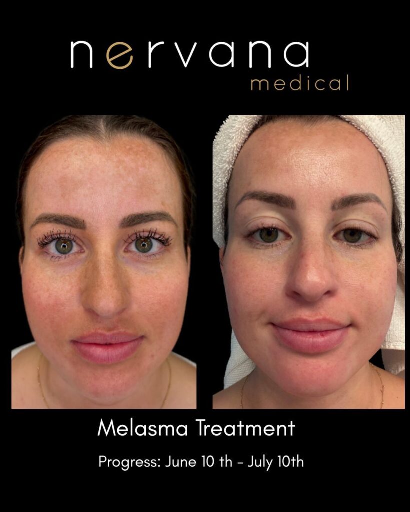 Before and After Image: At Home Melasma Treatment - front