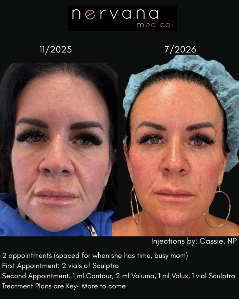 Before and After Image: Sculptra and Filler - front