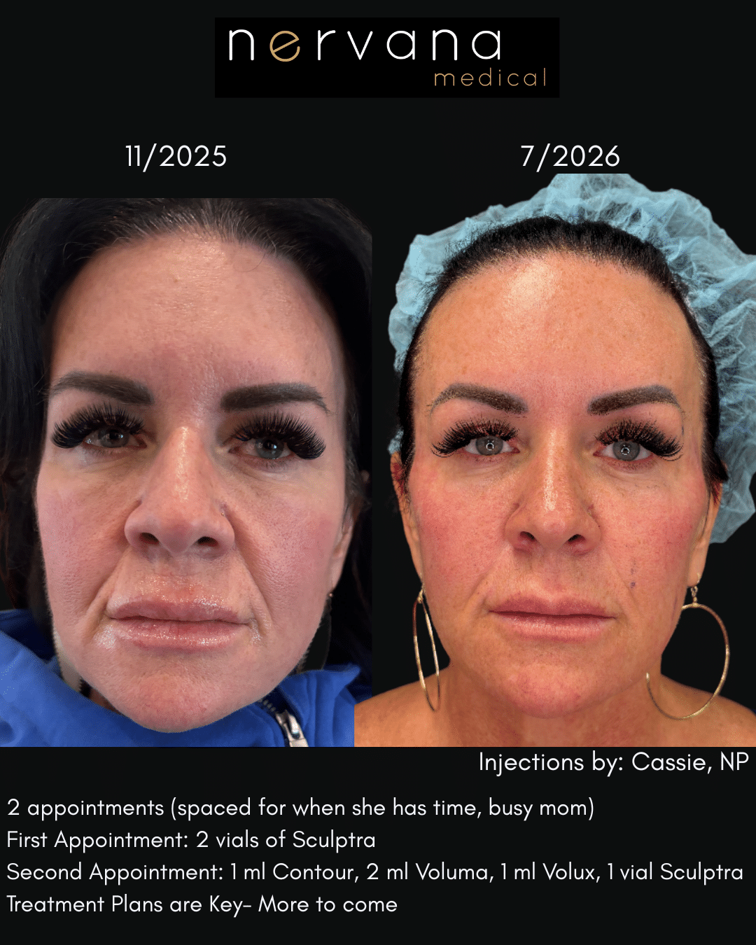 glutathione iv salt lake city Sculptra in Sandy, UT M Beauty by Dr. Brighten uneven skin tone Amount:3 Week Intensive Course - 1ml Every 3 Days
