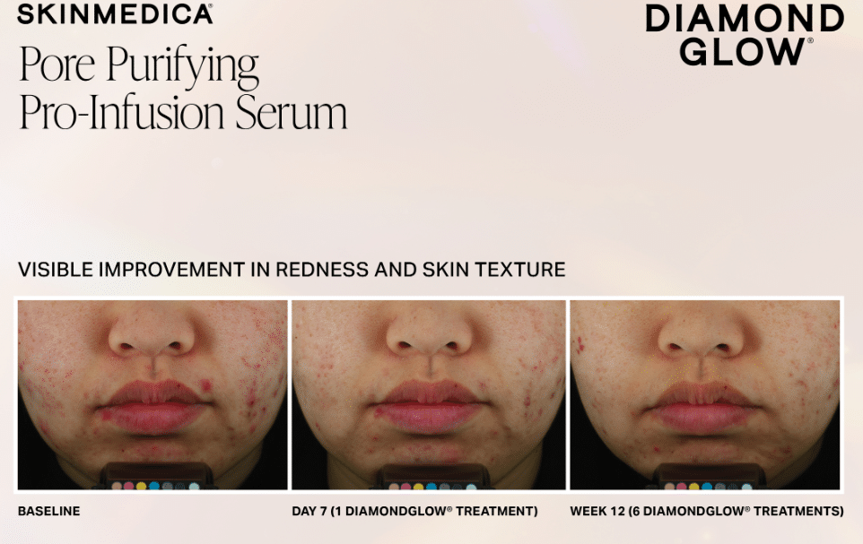 The DiamondGlow Facial in Sandy, UT: Exfoliate, Extract, and Infuse in One Visit