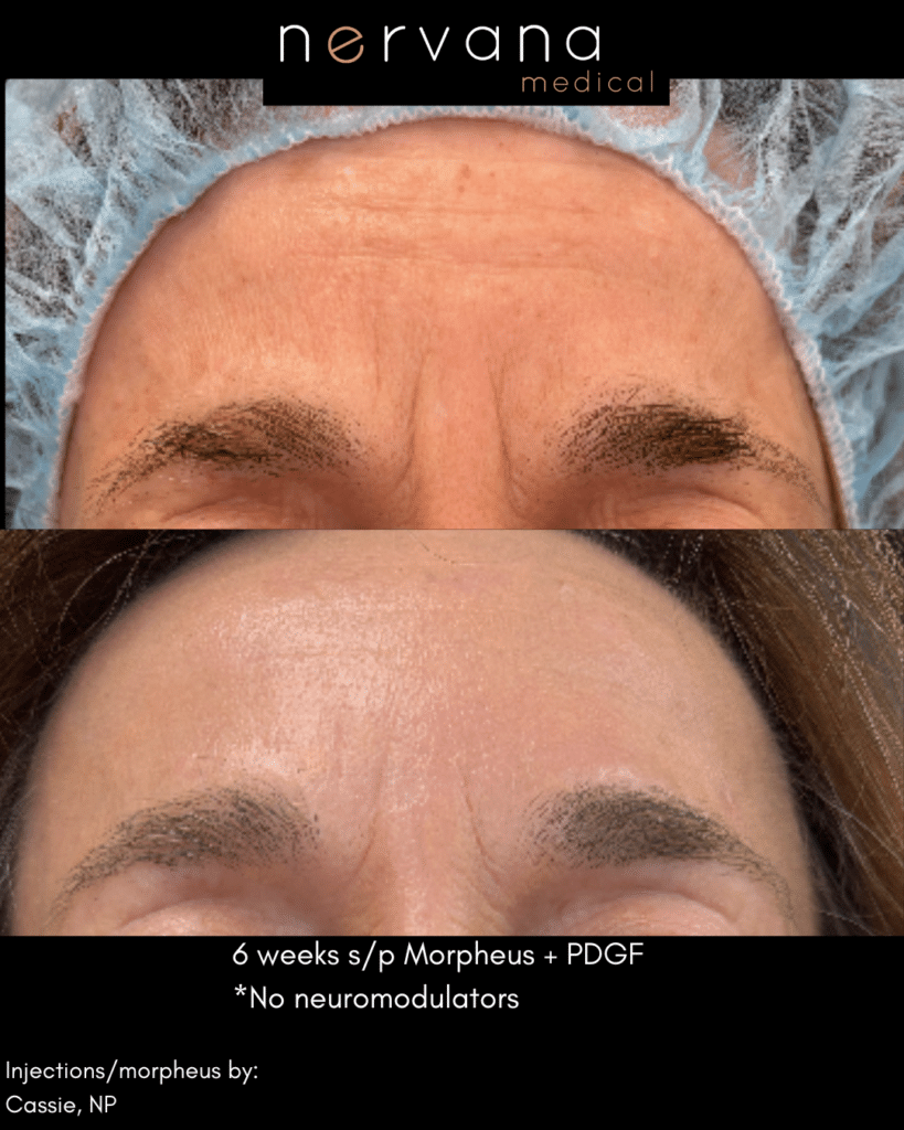 Before and After Image: Forehead Wrinkles… - front