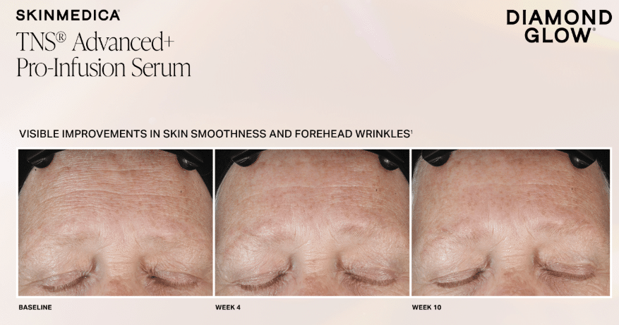 The DiamondGlow Facial in Sandy, UT: Exfoliate, Extract, and Infuse in One Visit