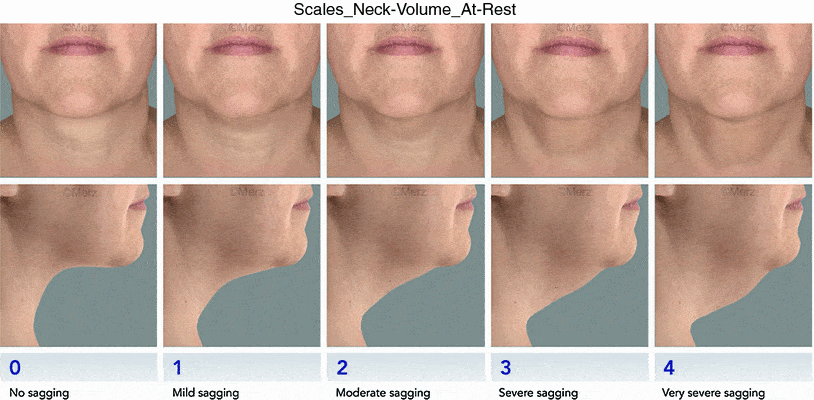 merz neck laxity scale Biostimulators (Radiesse, Sculptra) in Sandy, UT