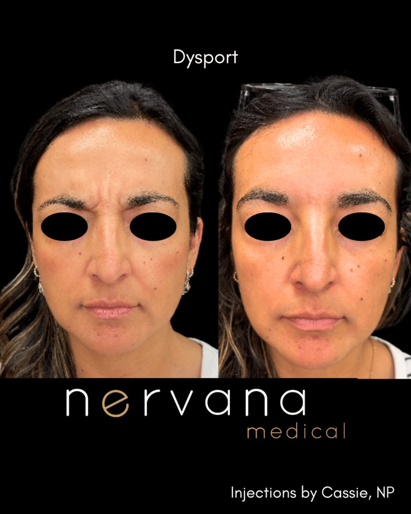 Before and After Image: Dysport - right-front-oblique