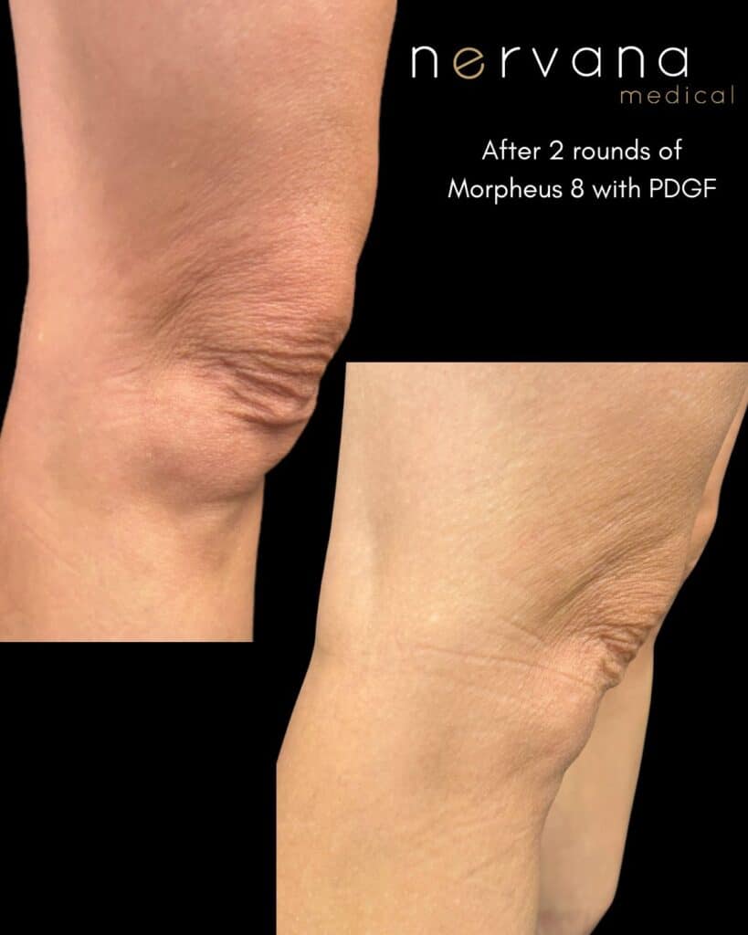 Before and After Image: Morpheus8 -Knees - front