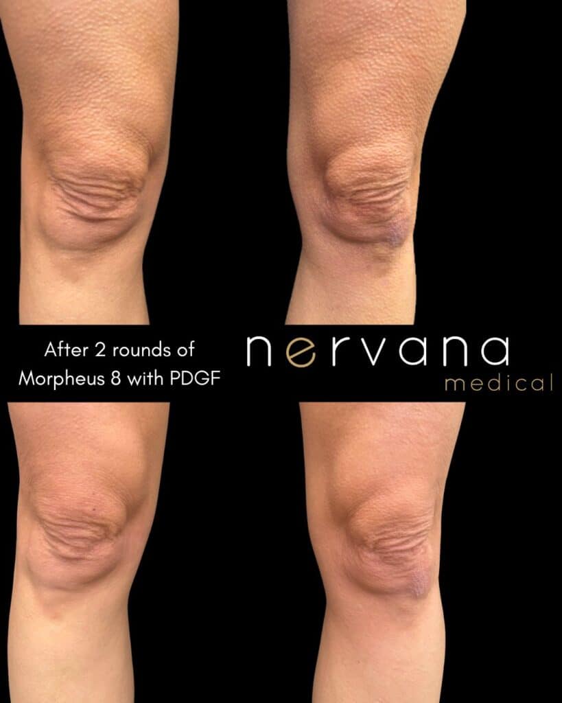 Before and After Image: Morpheus8 -Knees - right-front-oblique