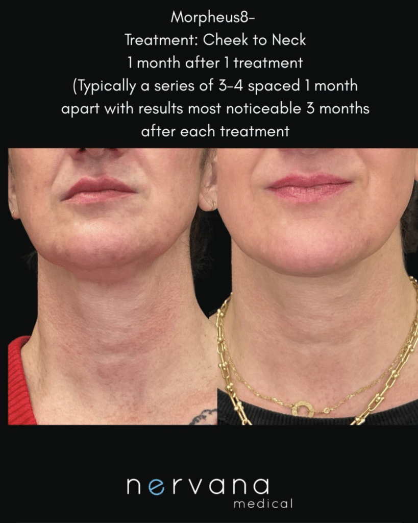 Before and After Image: Morpheus8 Cheek to Neck - front
