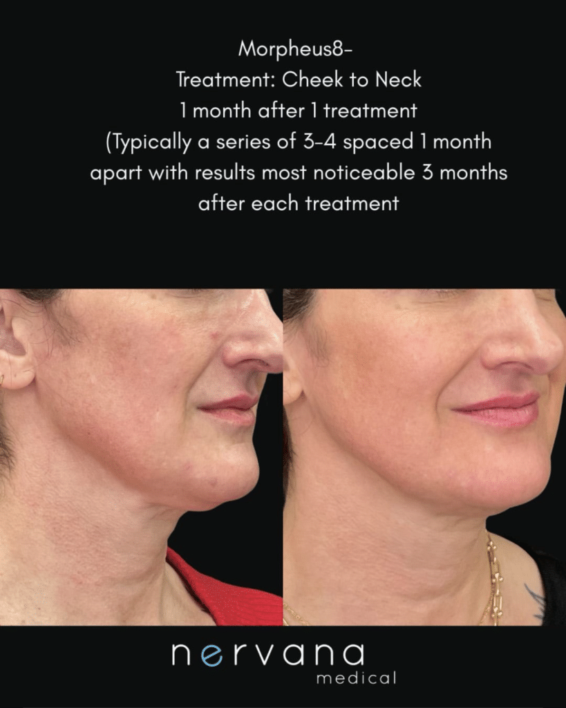 Before and After Image: Morpheus8 Cheek to Neck — Before & After - right-front-oblique