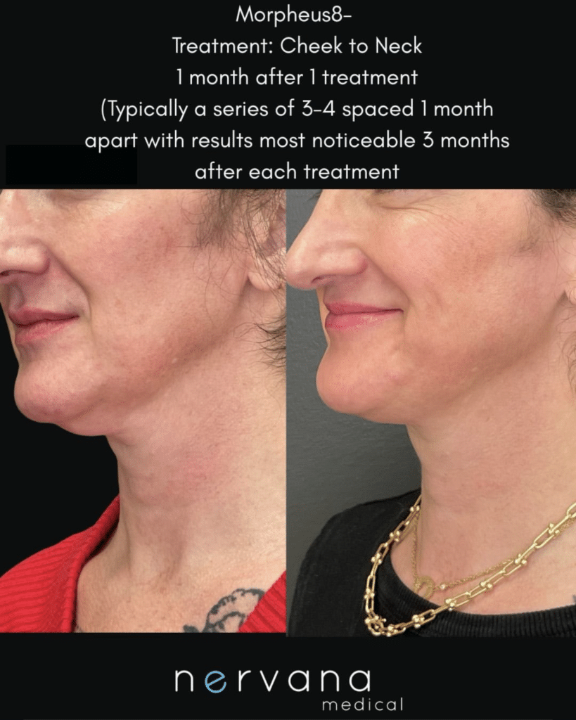 Before and After Image: Morpheus8 Cheek to Neck — Before & After - left-front-oblique