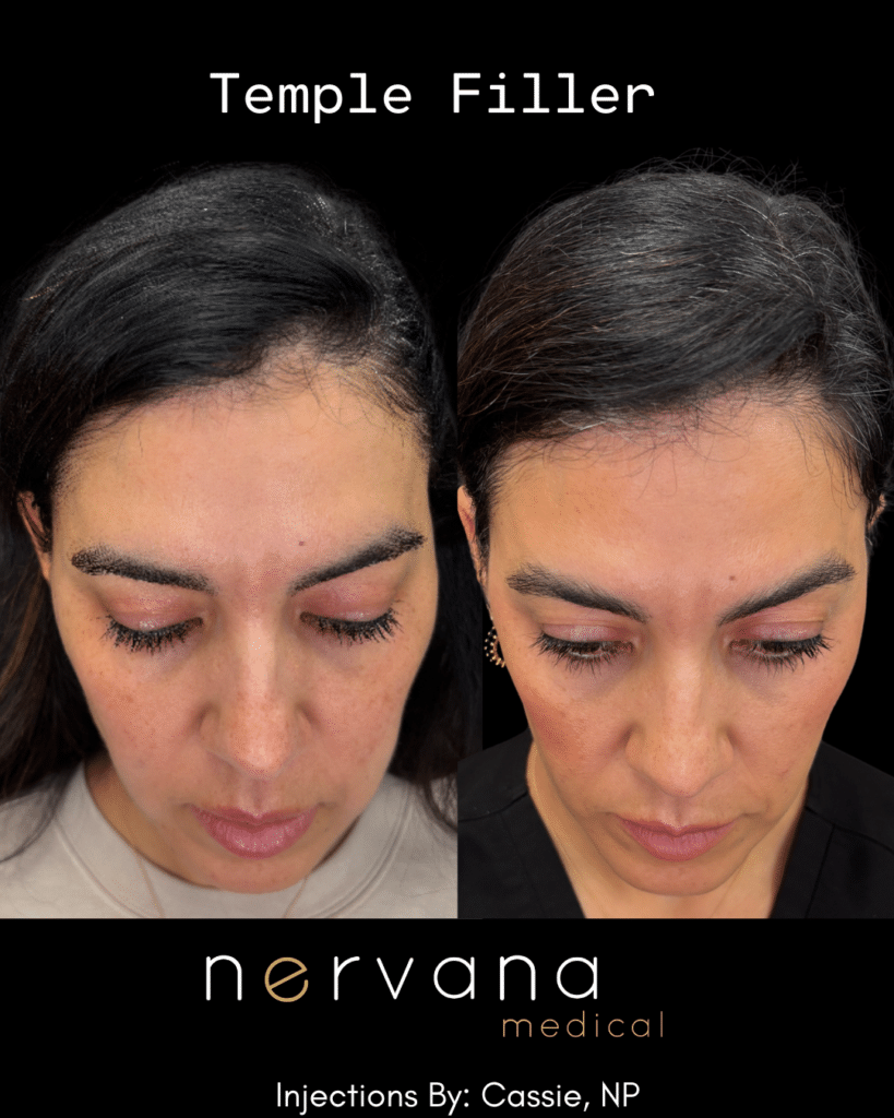 Before and After Image: Temple Filler - front