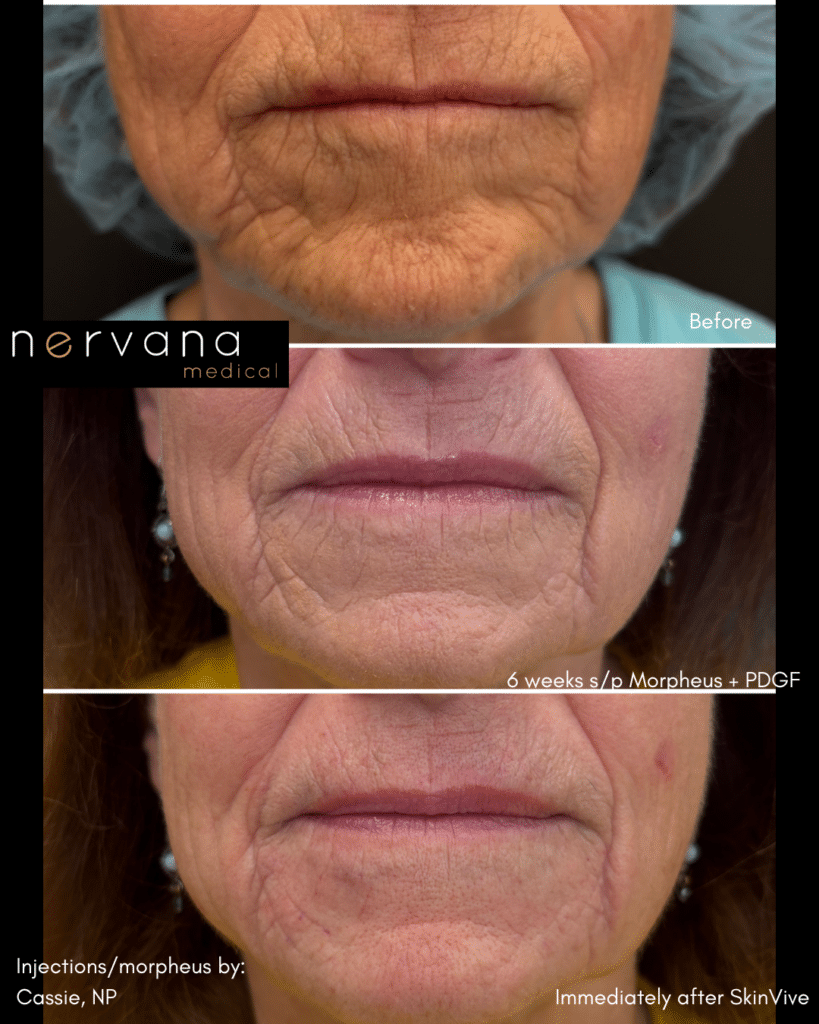 Before and After Image: Morpheus, PDGF, Skin Vive - front