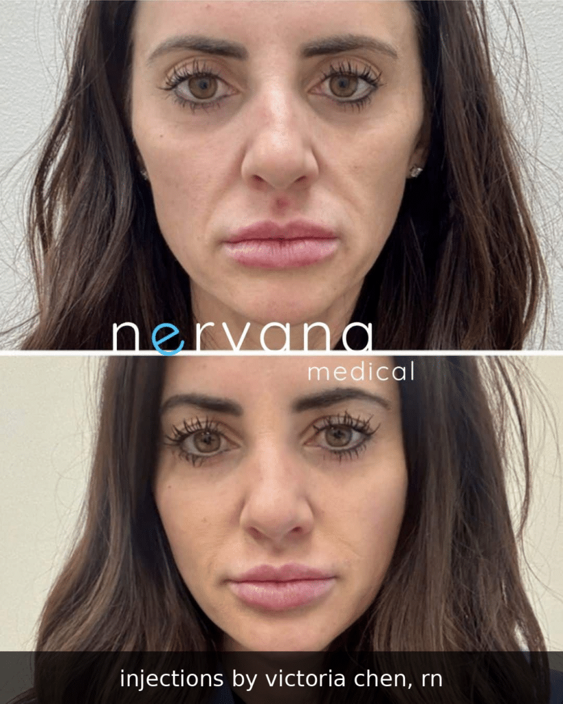 Sculptra and filler before and after at Nervana Medical, injections by Victoria Chen, RN